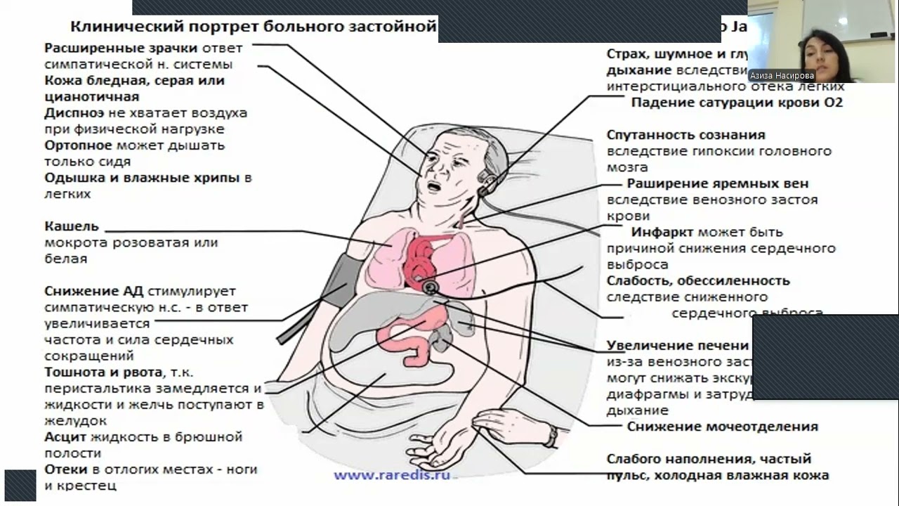 Хроническая сердечная недостаточность