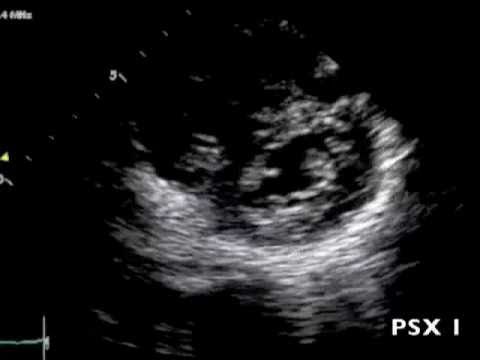 Bedside Echo in Pulmonary Embolism • LITFL • Clinical Cases Curveball
