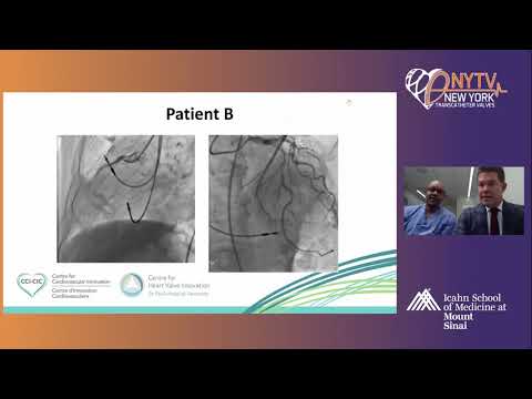 TAVR and CAD: Rationale and Design of the COMPLETE TAVR Trial - David A. Wood, MD