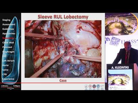 A. Kleontas - Extended resections for lung cancer