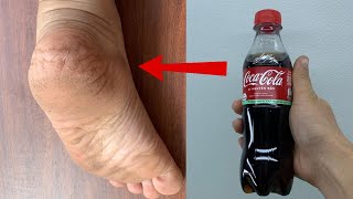 Get Rid of CRACKED HEELS Permanently, Magical Cracked Heels Home Remedy