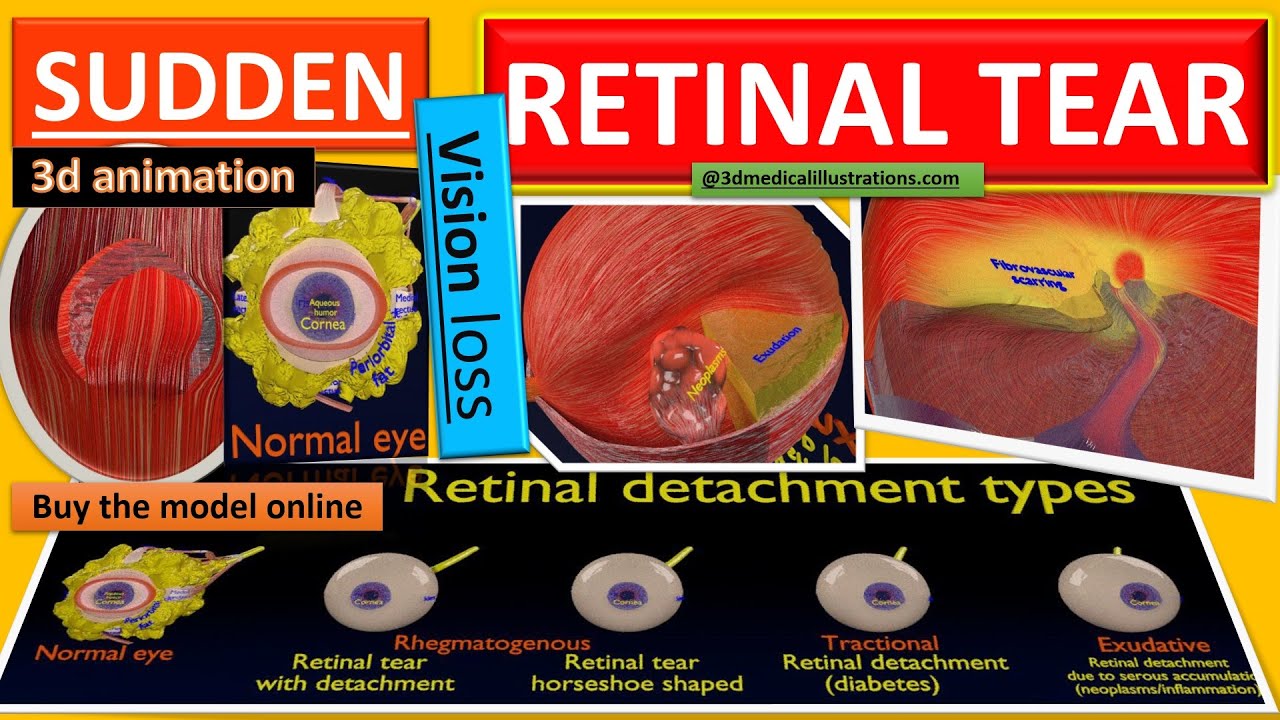 Retinal detachment types eye 3D Model