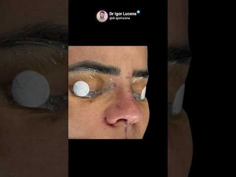 Rinoplastia #drigorlucena #consultaonline #rinoplastiabahia #ilheus