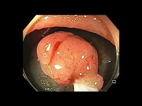 Colonoscopy: Proximal Ascending Colon Flat Lesion EMR