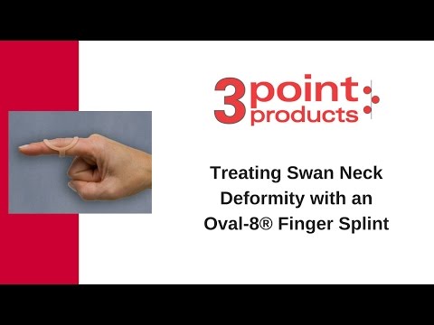 How to Treat Swan Neck Deformity with an Oval-8 Finger Splint - 3-Point Products