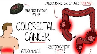 Surgical Treatments for Rectum Removal