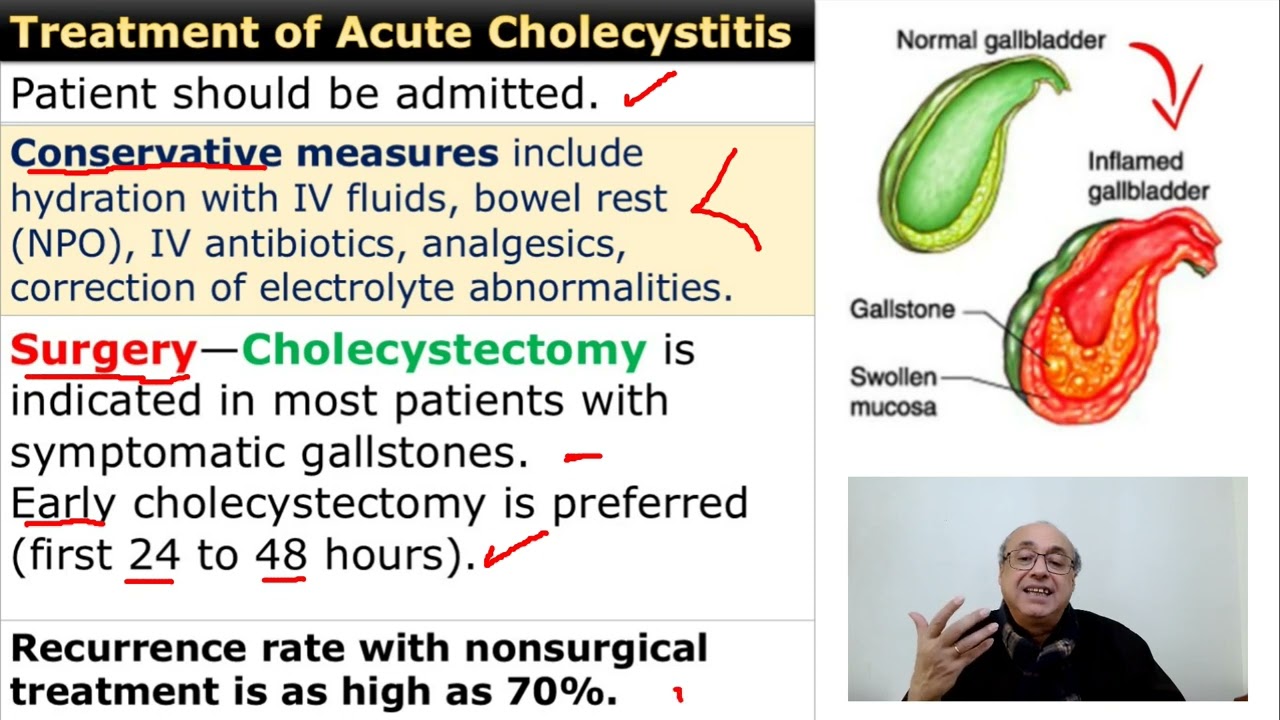 Acute Cholecystitis