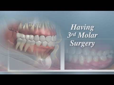 Having Third Molar Surgery