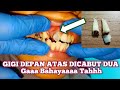 Gigi Depan Maunya Dicabut Saja Gak Bahaya Tah