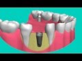 Periodontist Implant Dentist Gum Infection Orange County Video 2