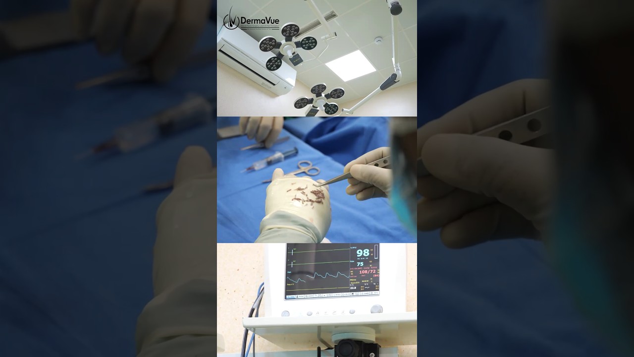 Patient Review — Hair Transplant at DermaVue Kerala