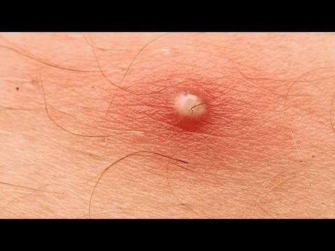 download lagu mp3 mp4 Furoncle Fessier Image, download lagu Furoncle Fessier Image gratis, unduh video klip Furoncle Fessier Image