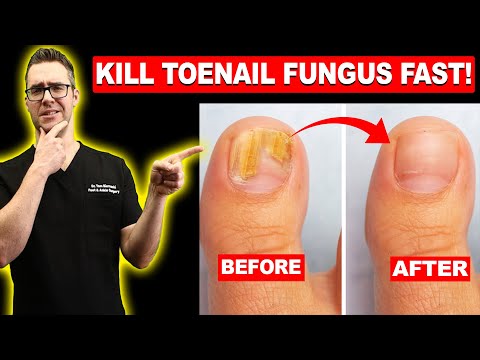 , title : '#1 BEST Toenail Fungus Treatment? [Top 10 Home Remedies] 2024'