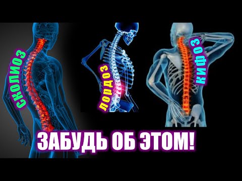 Сколиоз и занятия пилатесом Лечебная гимнастика при s-образном сколиозе