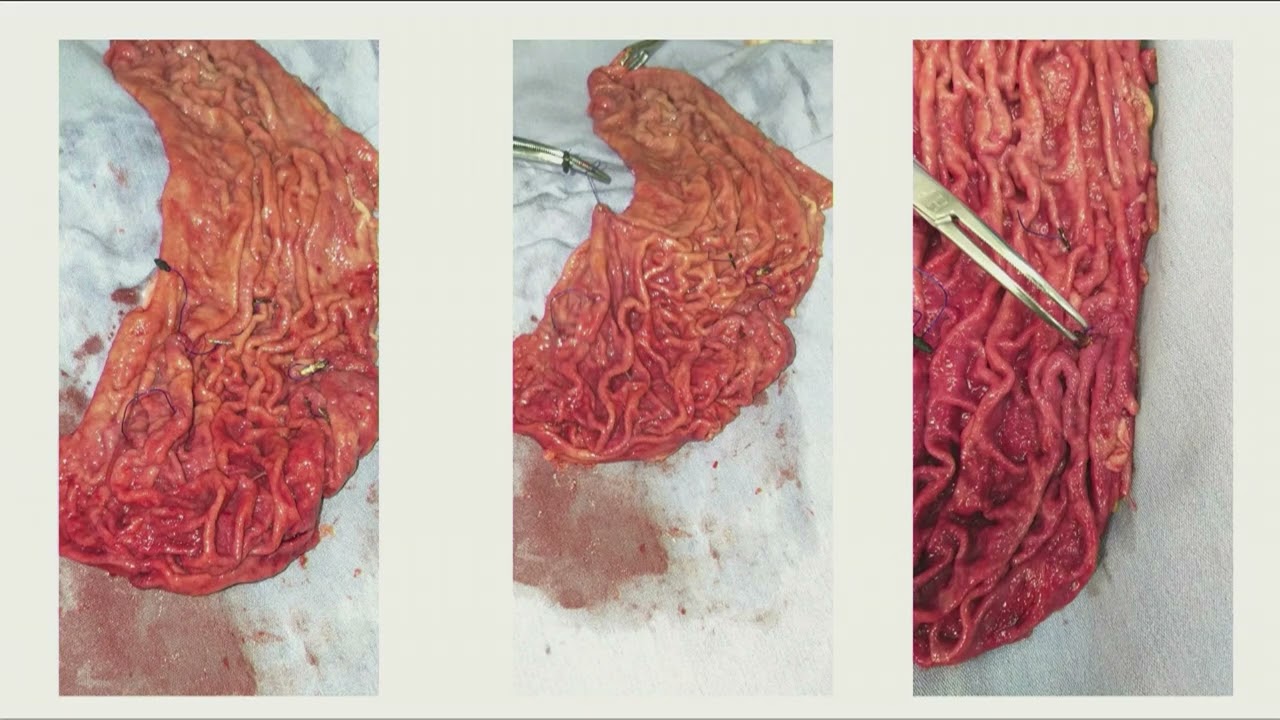 Conversión de Gasatroplastia Endoscópica / Dr Natal Zundel