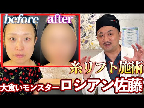 【糸リフト】ハングリーMonsterロシアン佐藤さんに感動糸リフト施術! 驚きのビフォーアフター!