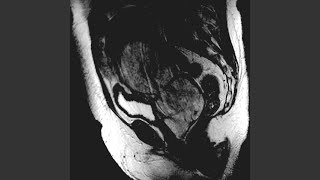 Carcinosarcoma