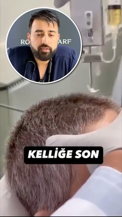 Hair Growth Treatment | Hair loss solution - PRP and Exosomes