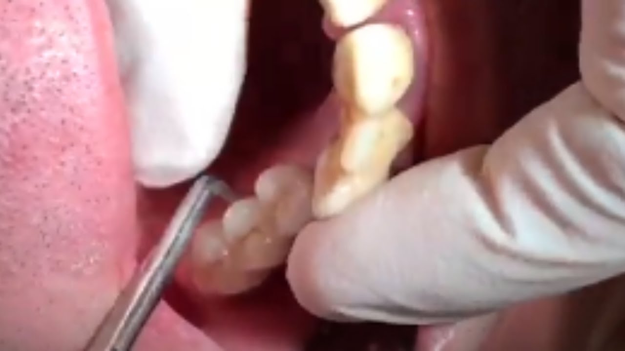 Levacorone — Magnetic Mallet crown removal — second demonstration