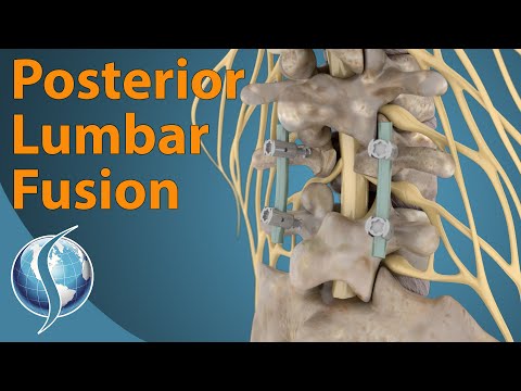 Posterior Lumbar Fusion