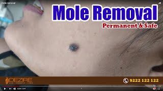 Mole Removal in Delhi | Face Mole Removal Treatments | How to Remove Moles ? | Live | Dezire Clinic