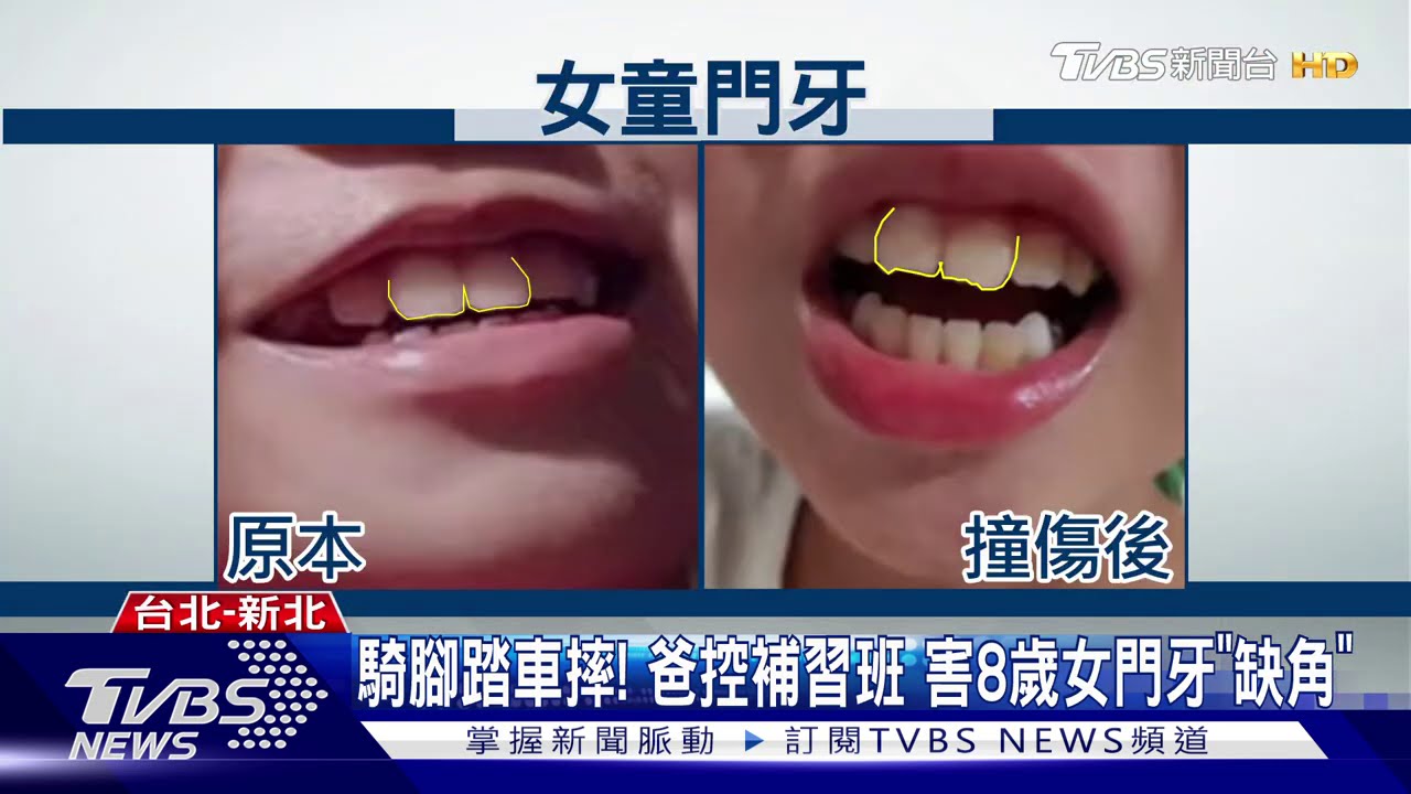 騎腳踏車摔!爸控補習班 害8歲女門牙「缺角」