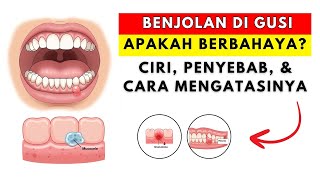 Download lagu Apakah Benjolan di Gusi Berbahaya? Ciri, Penyebab, dan Cara Mengatasinya mp3 Download lagu Apakah Benjolan di Gusi Berbahaya? Ciri, Penyebab, dan Cara Mengatasinya mp3