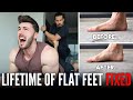 FIXING A LIFETIME OF FLAT FEET | Extremely Painful but Worth it...