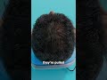 How Scalp Reduction Surgery Works