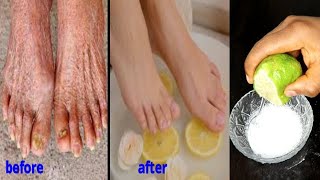 remove old legs remove wrinkle from foot 5 mins feet treatment