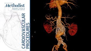 Download Lagu Salvage of a Fractured Endologix Stent Graft (Alan B. Lumsden, MD, Mujeeb Zubair, MD) Thumbnail