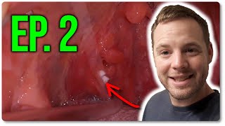 Tonsil Stone Removal With The Irrigator - Ep. 2 - Cutting The Cheese