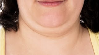 How to Get Rid of Double Chin Fast