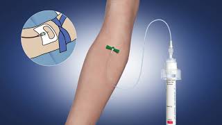 Initial Specimen Diversion Tube from C-Quest Medical