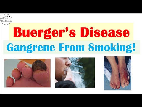 Buerger’s Disease (Ulcers & Gangrene From SMOKING!) Pathophysiology, Symptoms, Diagnosis, Treatment