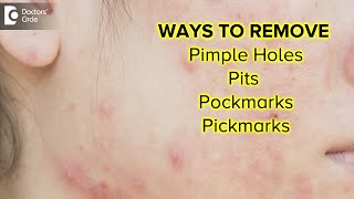 Pits, pockmarks, pick marks, permanent holes on face | BEST TREATMENT-Dr. Nischal K| Doctors