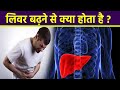 लिवर बढ़ने से क्या होता है | लिवर बढ़ने के लक्षण | Liver Badhne Se Kya Hota Hai | Boldsky