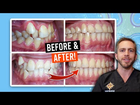 BRACES for MODERATE CROWDING! [BEFORE & AFTER]