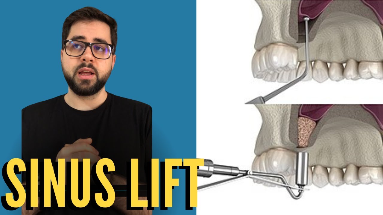 Sinus Lift Procedure