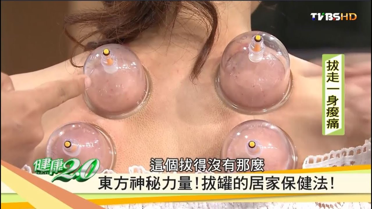 【健康2.0】拔罐的居家保健法！瘀血顏色藏身體警示