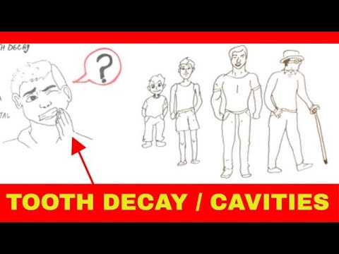 Stages of Tooth Decay / Cavities