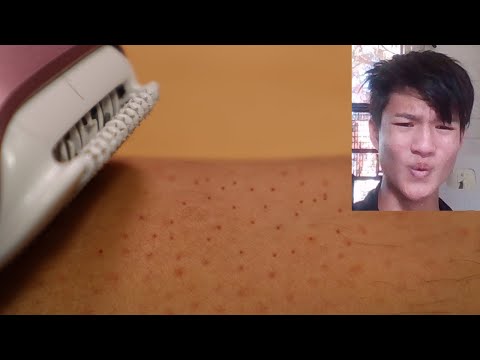 Pulling out my leg hair with epilator, then putting alcohol on my legs