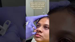 Dark Circle Treatment with Fillers at Laser Treat