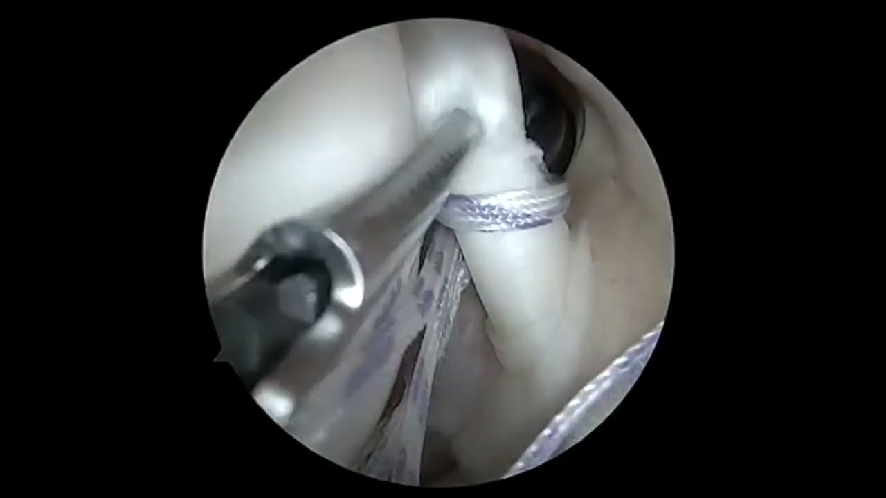 New Biceps Tenodesis with 360 labral repair