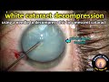 intumescent white cataract needle decompression