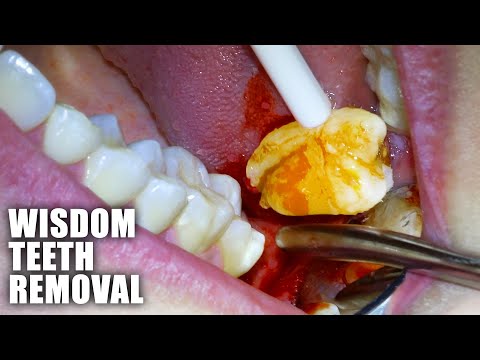 Full Wisdom Teeth Removal Procedure - Emergency Extraction of Impacted & Partially Erupted Molar