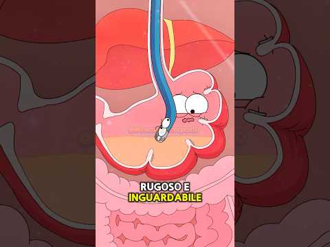 🥩Perché l'endoscopia aiuta a perdere peso?❓#shorts