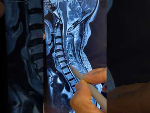 Cervical canal stenosis treatment 