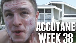 Accutane Week 38 - All Day in the Sun in Huntington, Acne Scars and Red Marks!