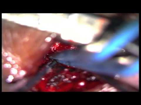 Lumbar microdiscectomy surgery